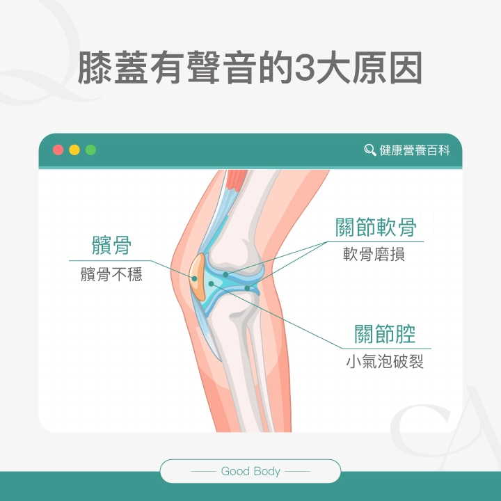 膝蓋有聲音的三大原因:1. 小氣泡破裂,2. 軟骨磨損,3. 髕骨不穩定